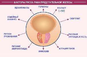Рак простаты – это злокачественная опухоль тканей предстательной железы